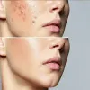 acne & acne scar