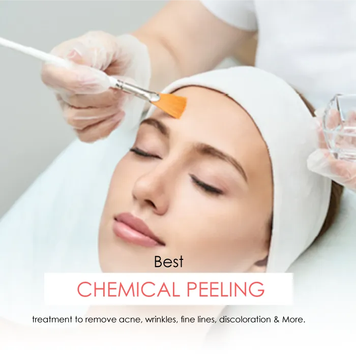 chemical peel treatment