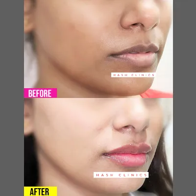 skin whitening injection before after