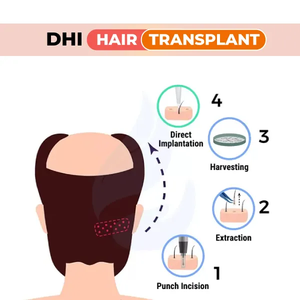 dhi hair transplant