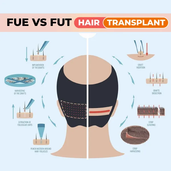 fut hair transplant