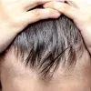 hair fall treatment