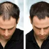 hair regrowth using pe-r-pe