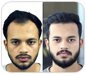 hair transplant in karachi