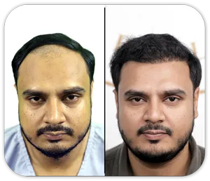 fue hair transplant in karachi