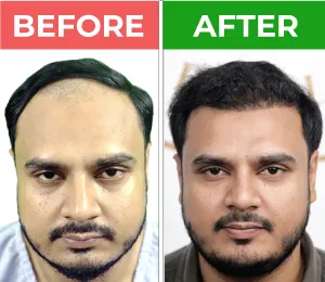 hair transplant before after