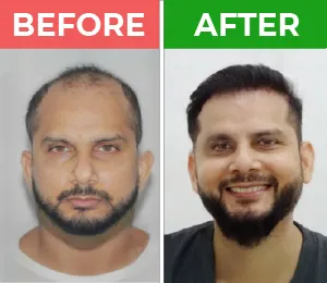 hair transplant in karachi