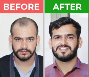 hair transplant in karachi