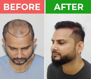 hair transplant in karachi