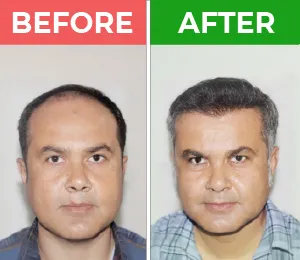 hair transplant in karachi