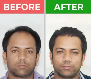 hair transplant in karachi