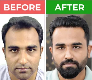 hair transplant 