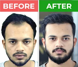 hair transplant before after