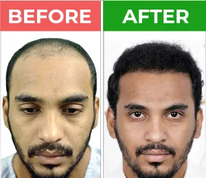 hair transplant in karachi