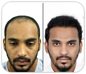 fue hair transplant before after