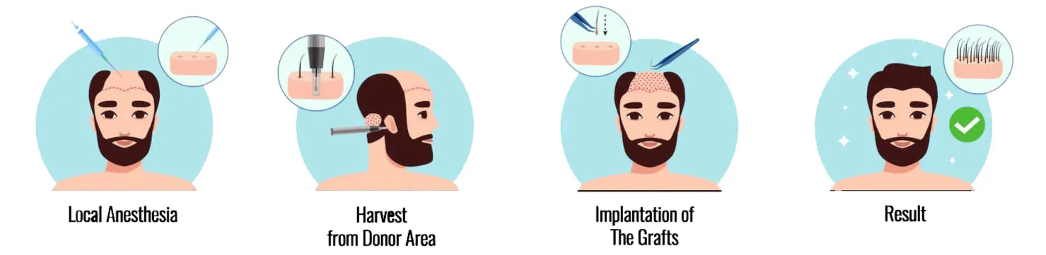 hair transplant steps