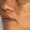 hyperpigmentation treatment