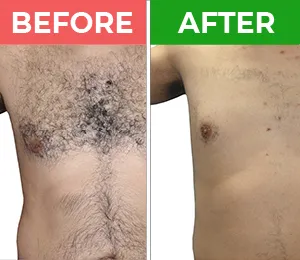 laser hair removal