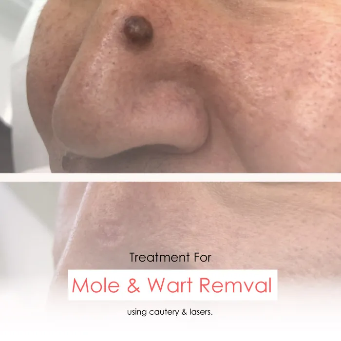 mole warts skin tags removal