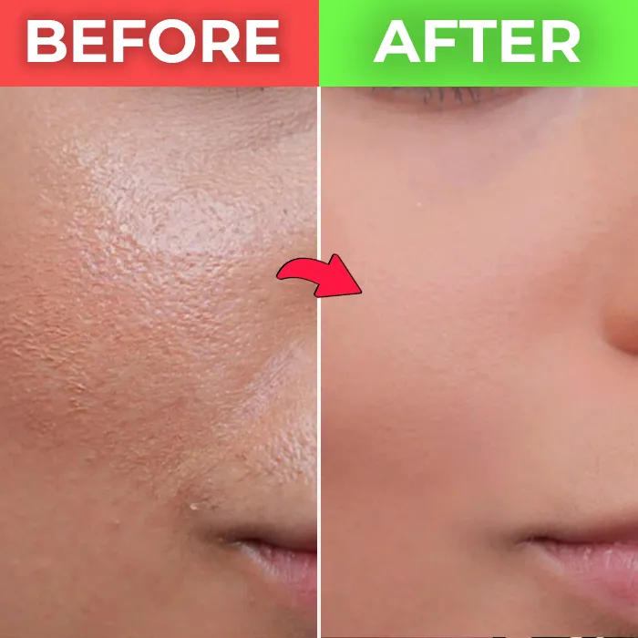 open pores treatment