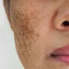 pigmentation treatment