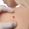 skin moles removal