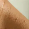 skin tags removal