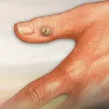 warts removal