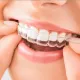 teeth aligners