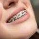 teeth braces