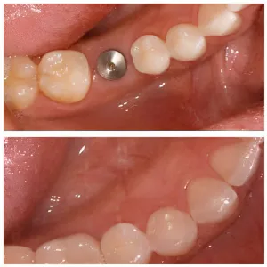 dental implant