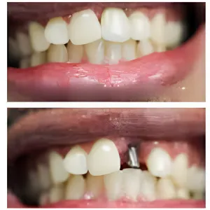 implant before after