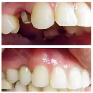 implant after