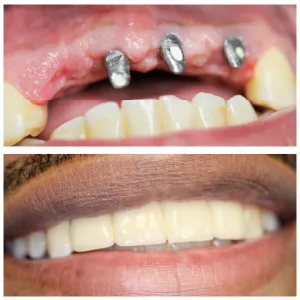 teeth implant
