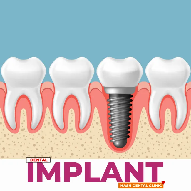 dental implant