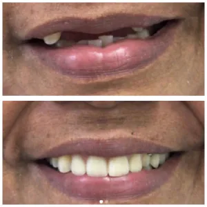 dentures treatment 