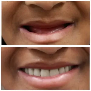 dentures before after