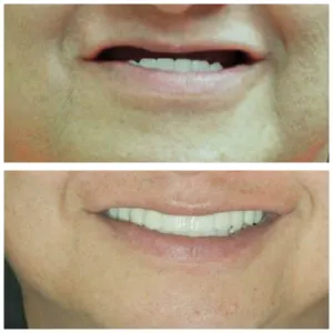 dentures before and after