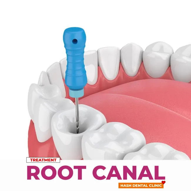 root canal treatment