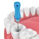 root canal treatment