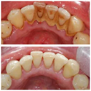 teeth scaling and polishing