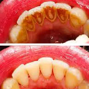 scaling and polishing 