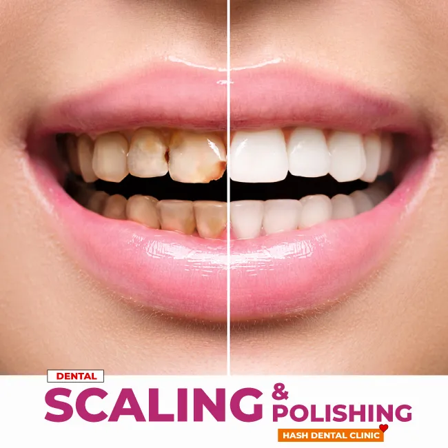 scaling and polishing