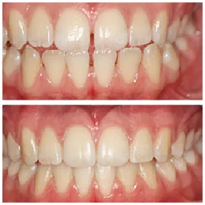 teeth braces before after