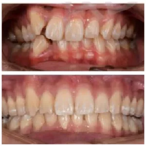 braces before after 