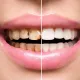 teeth scaling and polishing