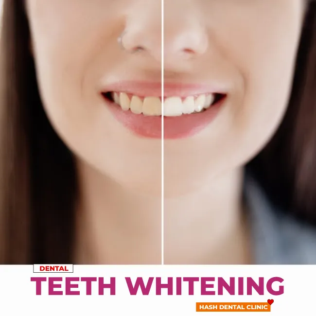 teeth whitening