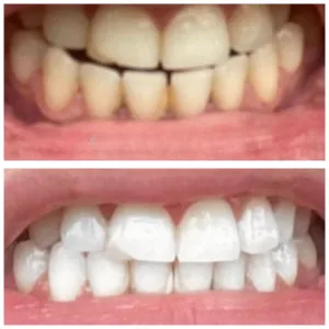 teeth whitening before after 