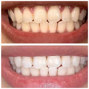 teeth whitening treatment