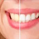 teeth whitening treatment